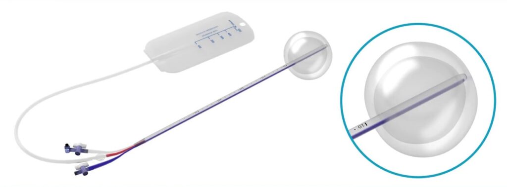 Cathéter avec ballon pour hémorragie utérine post-partum